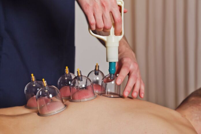 Cupping Karim Benzemas Muscle Recovery Method