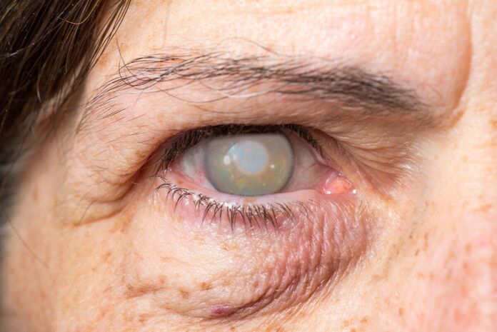 What is macular edema