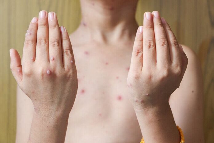 Shingles In Children Causes Symptoms And Treatments