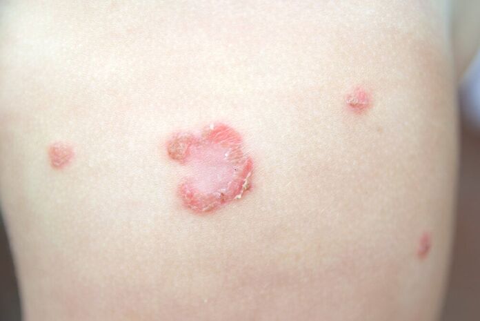impetigo in children