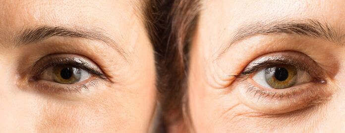 Blepharoplasty Surgery to remove bags under the eyes
