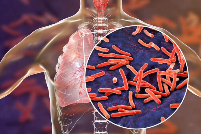How is tuberculosis spread and what is its treatment
