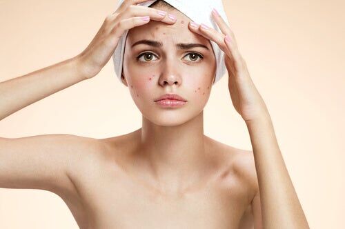 home remedies to fight acne
