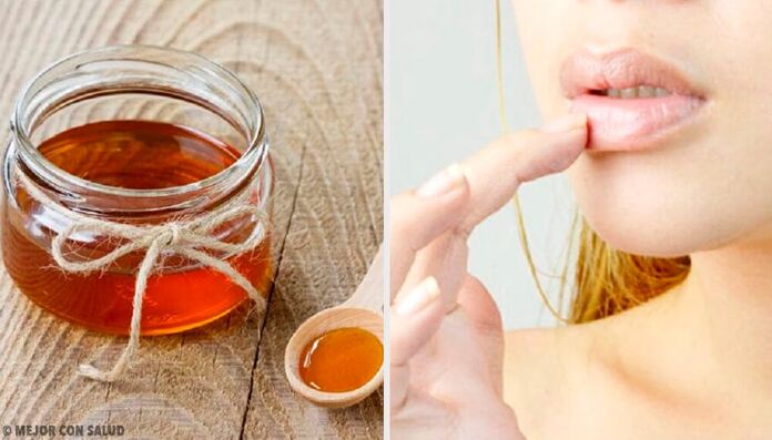 natural remedies for chapped lips