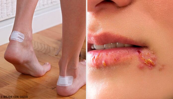 Solutions to eradicate blisters and achieve effective healing