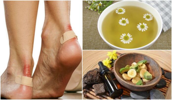 Soothe itchy feet with these natural solutions