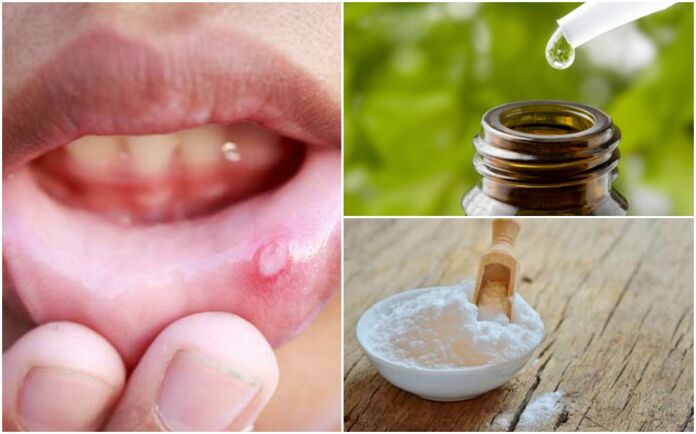 Relieve canker sores using these natural remedies