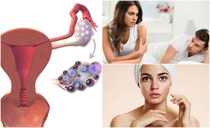 PCOS Symptoms You Shouldnt Ignore