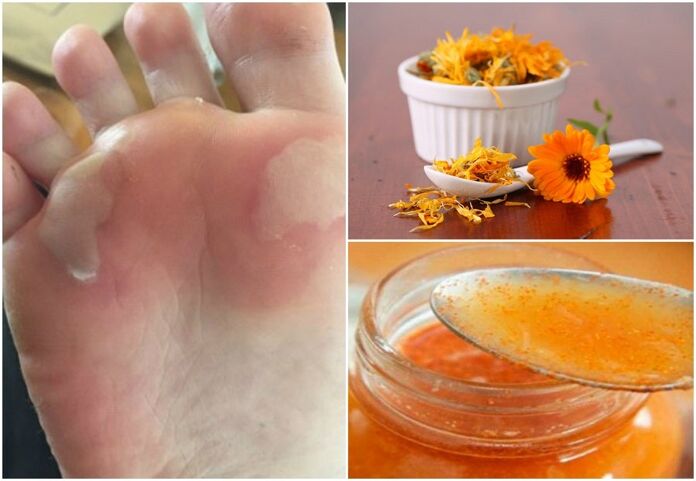 How to cure blisters on feet using home remedies